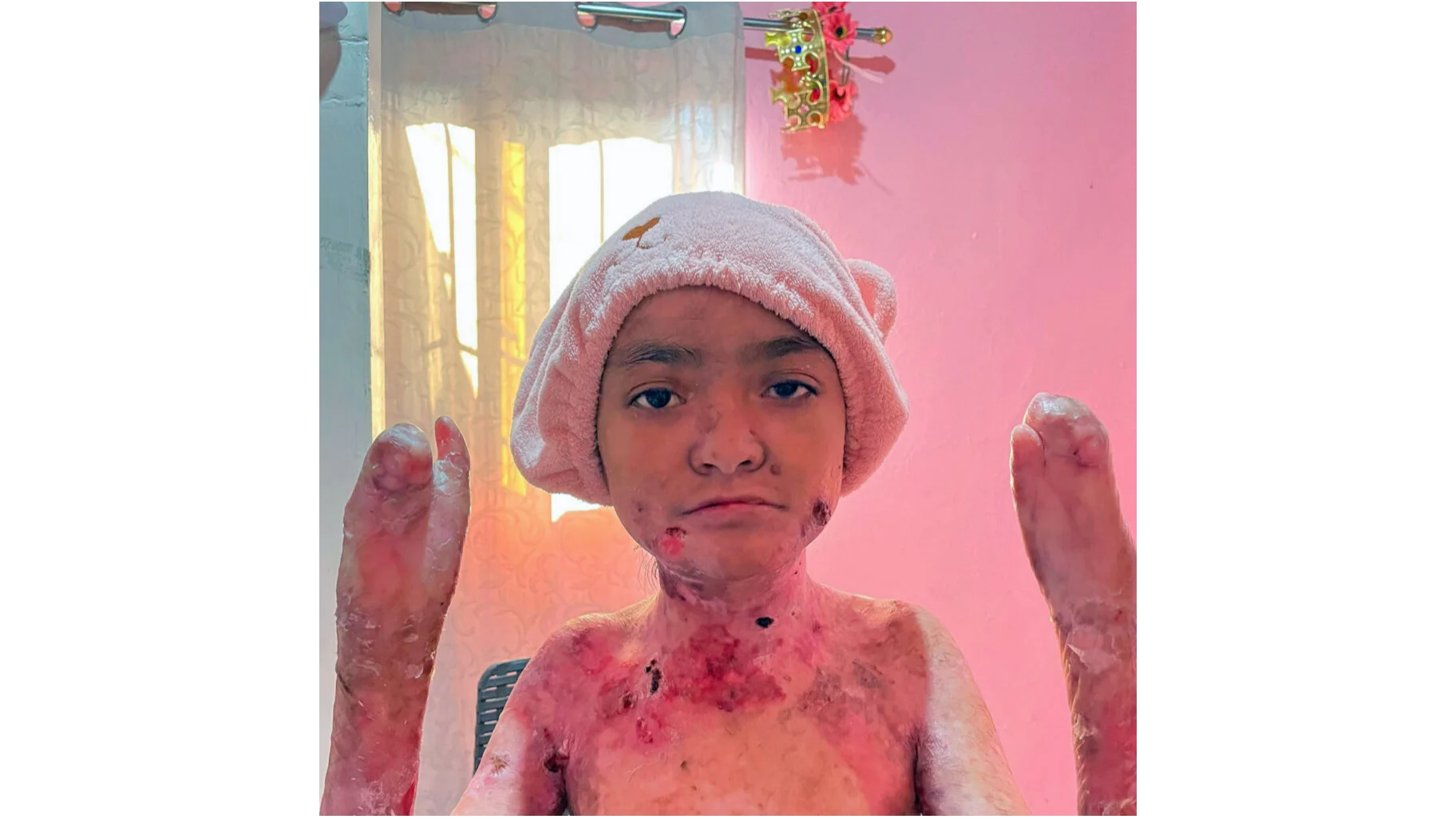 EB Skin Disease: Optimizing Pain Management During Pediatric Dressing Changes